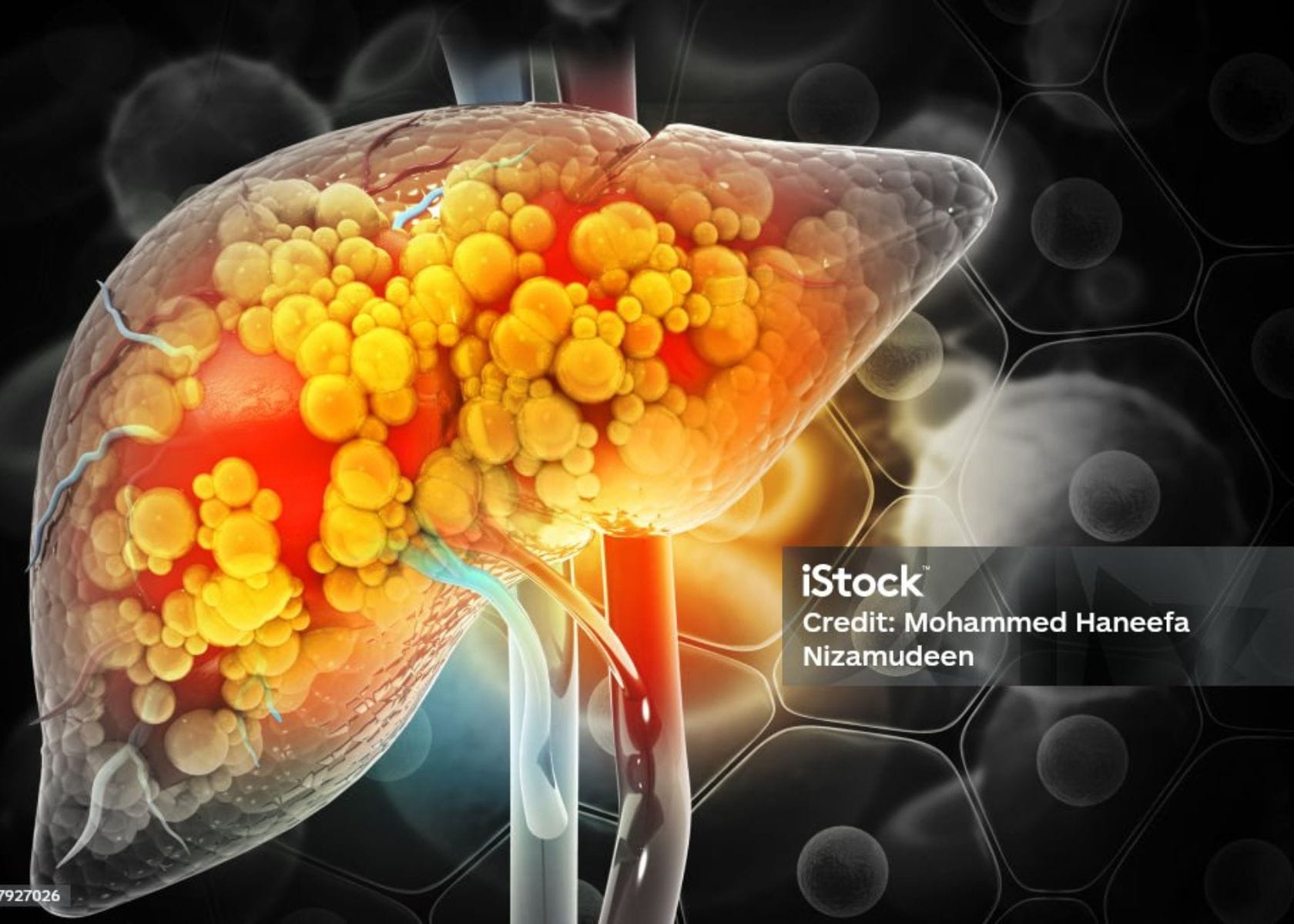 One Cause of Liver Cirrhosis